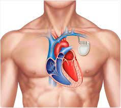 Pacemaker implantation in Jaipur