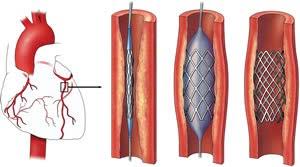 carotid angioplasty in Delhi