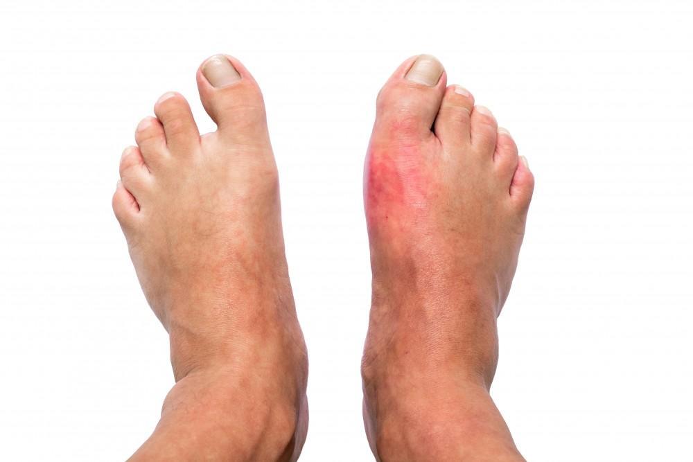 Peripheral Neuropathy